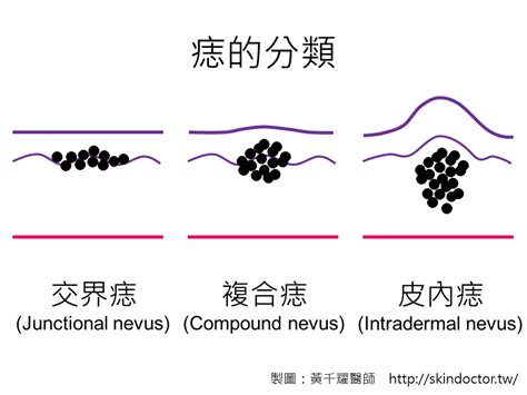 痣為什麼會凸起來|痣為什麼會凸起來？